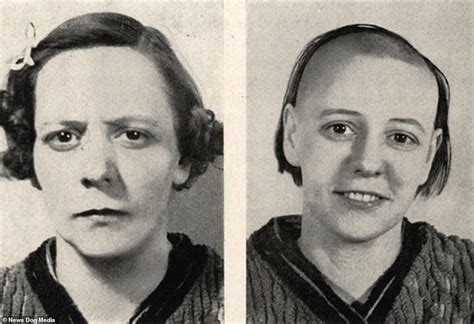 Yet the reason for getting lobotomized, her anxiety, had been reduced by the lobotomy and kept her out of mental institutions. Her husband remarked that she was acting more normal than before. Alice later contracted pneumonia and passed away at 68. Some lobotomy victims were assisted by the procedure. However, the side effects could differ wildly.